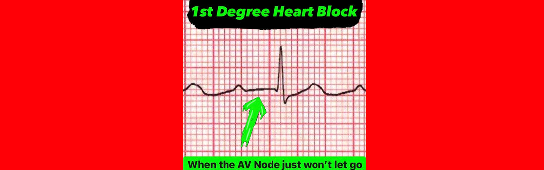 First Degree Heart Block || When the AV Node Just Won't Let Go