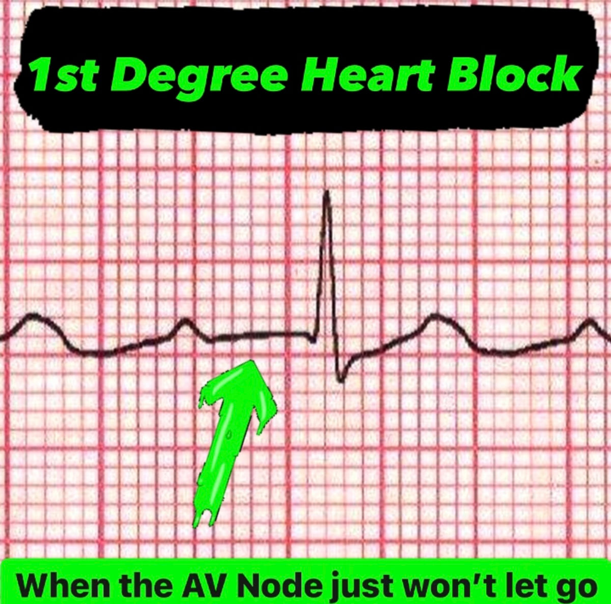 First Degree Heart Block || When the AV Node Just Won't Let Go – Lights ...