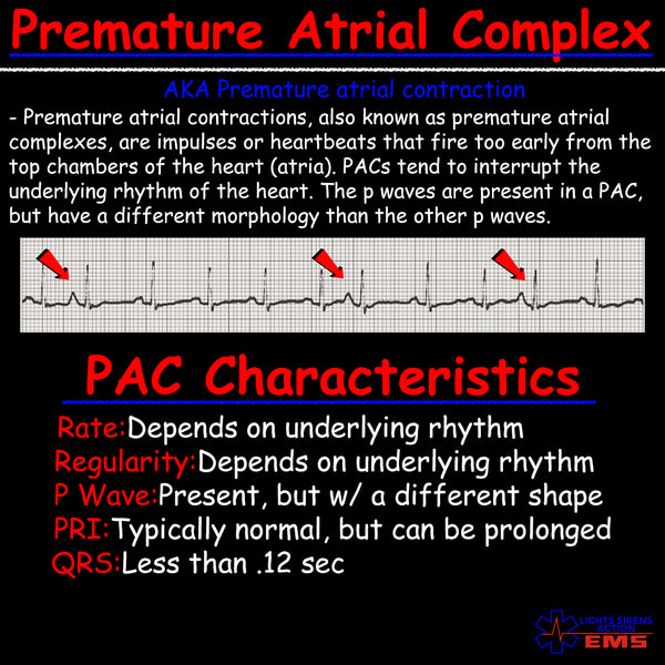 Premature Atrial Contraction || PACs in EMS