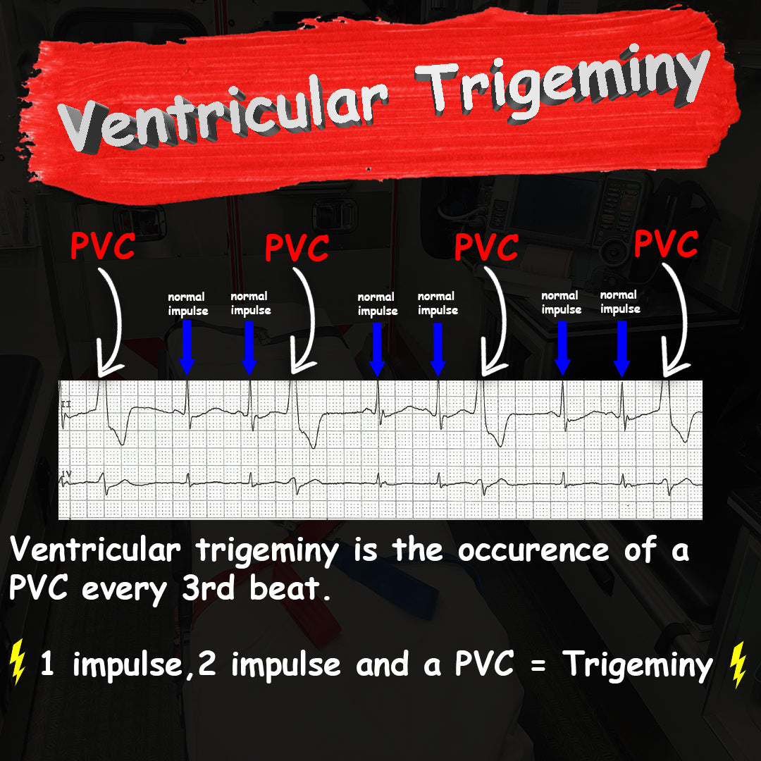 Ventricular Trigeminy || EMS Cardiology – Lights Sirens Action EMS